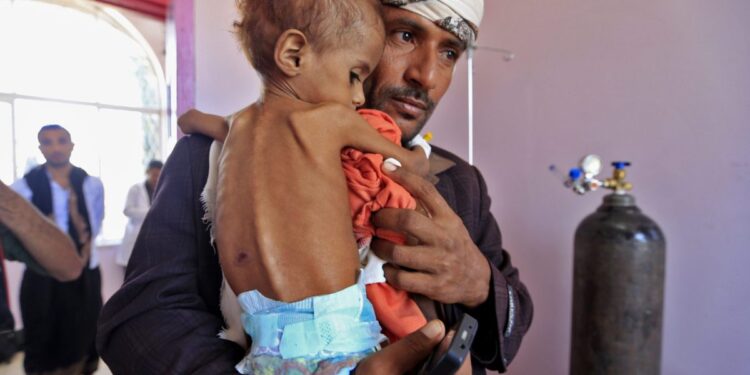 المأساة الإنسانية في اليمن تخضع للمصالح السياسية